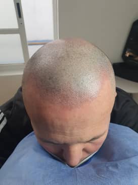 Slider image (2) SMP Advanced - Scalp Micro Pigmentation